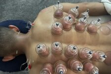 Chinese Cupping