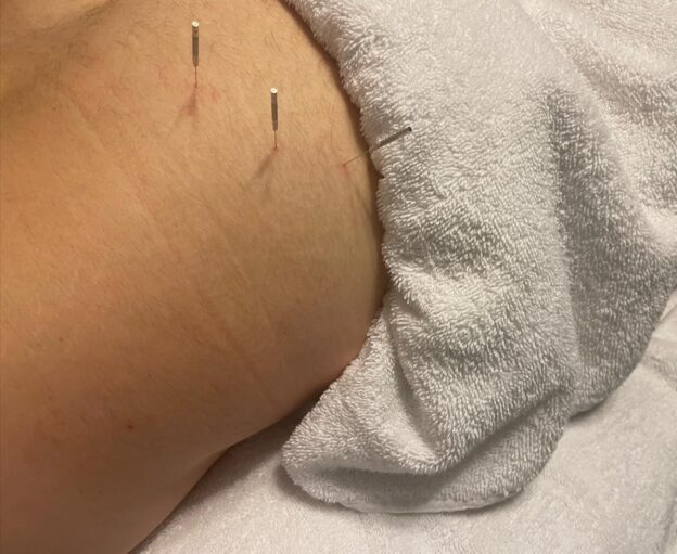 Dry Needling